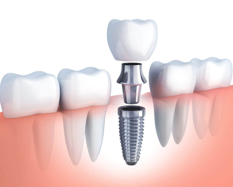 implant diagram 1536x12291 1, How to Prepare for Your First Dental Implant Placement