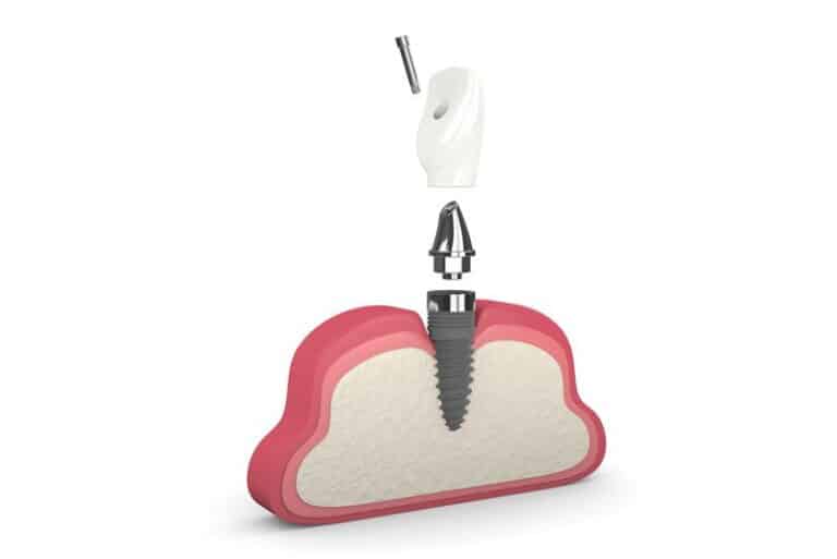 single dental implant and post, What Are The Benefits Of Dental Implants?