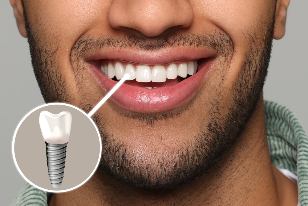 man with perfect teeth smiling closeup and Illustration of dental implant