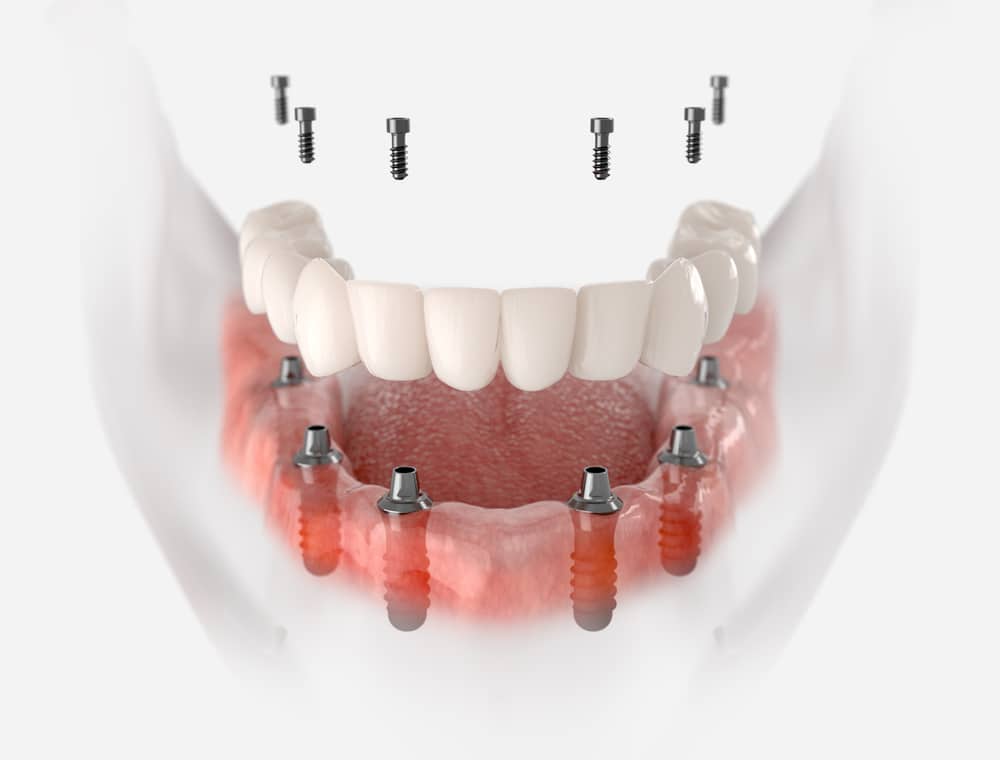 How Much Do Full-Mouth Dental Implants Cost? 1 3D illustration of full-arch dental implants