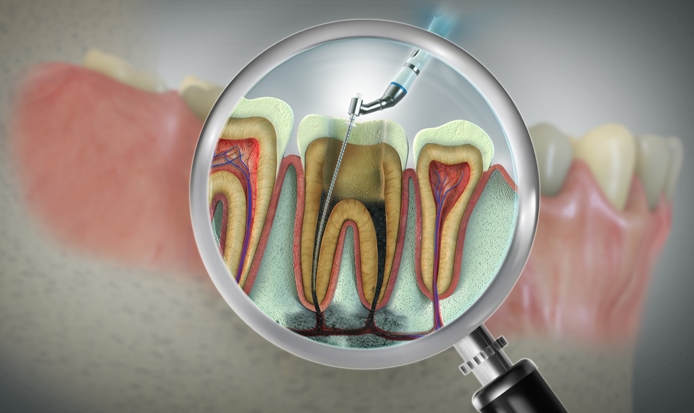3D illustration of endodontic root canal treatment
