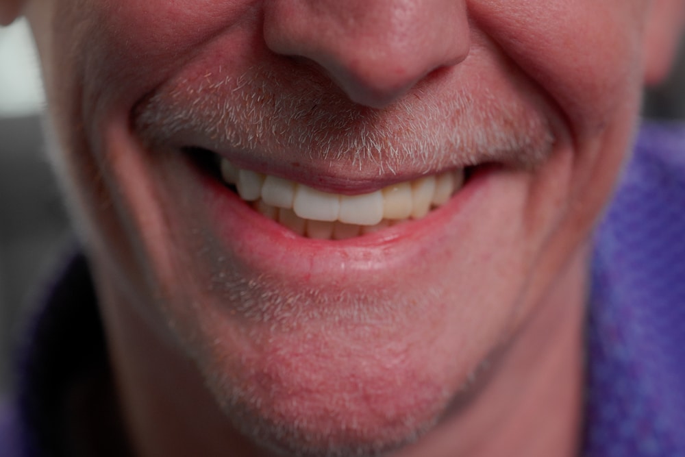 Custom At-Home Whitening Treatments