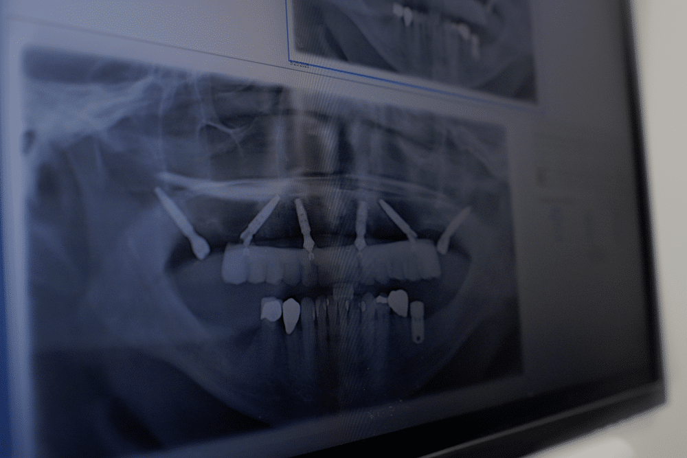 The Full-Arch Implant Process at Southeastern Dental Center in Georgia