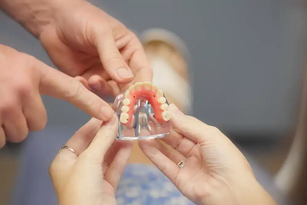 Understanding Full-Arch Dental Implants